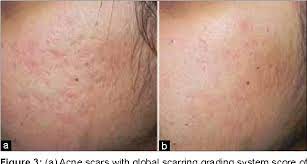 Table 1 From Retinoic Acid And Glycolic Acid Combination In The Treatment Of Acne Scars Semantic Scholar