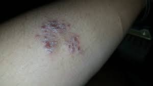 I have terrible eczema on my face were it is always very red day to day. Can You Get Rid Of Eczema For Good Favoriteplus Com Blog