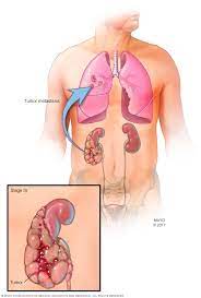 To control the cancer and its consequences, it is important to know how fast kidney cancer in the first stage, there are minimal cancerous cells in the kidney, which usually go unnoticed in the first. Kidney Cancer Diagnosis And Treatment Mayo Clinic