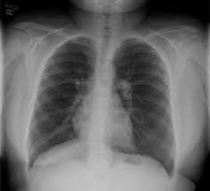 Foreign Body Ingestion Aspiration Undergraduate Diagnostic Imaging Fundamentals