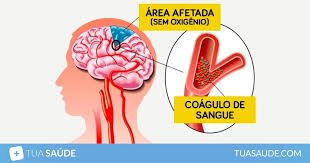 De los aneurismas cerebrales no presentan roturas, no crean problemas de salud y no causan síntomas. Trombose Cerebral O Que E Sintomas Causas E Tratamento Tua Saude