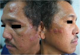 A patient with multiple nodules and plaques
