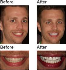 How to whiten teeth at home without harming the enamel? Whitening For Life Teeth Whitening Experts In Brooklyn Ny