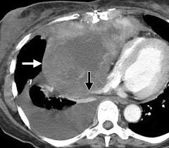 Multimodality Imaging For Characterization Classification And Staging Of Malignant Pleural Mesothelioma Radiographics
