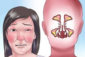 Karena dari saluran pernafasan itulah tubuh mendapatkan oksigen. Cara Mudah Mengatasi Hidung Tersumbat Beritasatu23 Blogspot Com