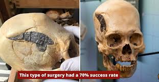 2,000-Year-Old Skull Shows Evidence of Ancient Surgery | The Vintage News