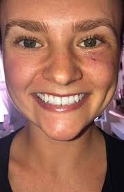 Common causes range from illness to injury to inflammation. Woman S Tiny Pimple Under Her Eye Was Actually Skin Cancer News Com Au Australia S Leading News Site