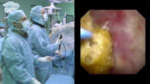 Stone Dusting Using A Holmium Laser Youtube