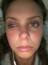 Woman left in 'excruciating pain' and partially blind due to dirty makeup  bag