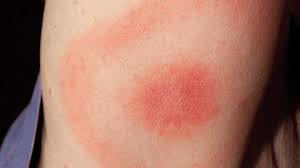 Skeeter syndrome is often found in medical books. Mosquito Bite Allergies Symptoms And Treatment