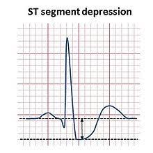 Dengan ekg, jantung iskemia bisa anda identifikasi berupa t inverted, t flat asalkan disertai dengan klinis khas koroner atau gambaran st segmen depresi dengan kriteria sebagai berikut : St Depression Wikipedia