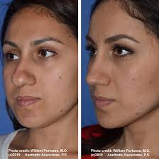 Maybe you would like to learn more about one of these? Rhinoplasty Seattle Wa Nose Surgery Nose Job Bellevue