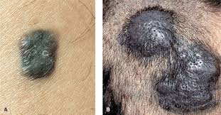 Image result for Blue Nevus