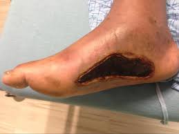 It is caused by a burn or cauterization (destroying tissue with heat or cold, or another method). Burn Debridement Grafting And Reconstruction Article