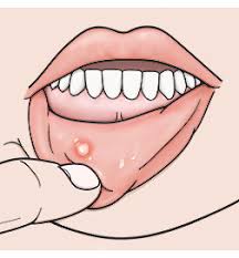 Blisters and sores in the mouth may be due to nutritional deficiencies, viral infection, trauma, oral hygiene issues, autoimmune disease etc. When Your Child Has Mouth Sores