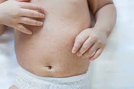 Image result for measles