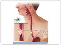 This technique involves a right thoracotomy, laparotomy, and left neck incision for creation of a cervical anastomosis (fig 2a, 2b). Ø¨Ù‡ Ù†Ø§Ù… Ø®Ø§Ù„Ù‚ Ù‡Ø³ØªÛŒ Esophageal Cancer Ø§Ø¹Ù…Ø§Ù„ Ø¬Ø±Ø§Ø­ÛŒ Ù†ÙˆÛŒÙ† Ø¯Ø± Ú©Ø§Ù†Ø³Ø±Ù‡Ø§ÛŒ Ù‚Ø³Ù…Øª Ù‡Ø§ÛŒ Ù…Ø®ØªÙ„Ù Ù…Ø±ÛŒ Ø¯Ú©ØªØ± Ù¾Ø±ÙˆÛŒØ² ÙÙ„Ø§Ø­ Ø¹Ø§Ø¨Ø¯ Ø¯Ø§Ù†Ø´ÛŒØ§Ø± Ø¯Ø§Ù†Ø´Ú¯Ø§Ù‡ Ø¹Ù„ÙˆÙ… Ù¾Ø²Ø´Ú©ÛŒ Ù‚Ø²ÙˆÛŒÙ† Ppt Download