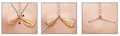 Hockey stick png,hockey stick carbon fiber,transparent png, png download, hd png #964288. Managing Patient Expectations Key For Mastectomy Without Reconstruction Clinical Oncology News