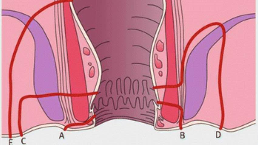 Complex Fistula Management in Shikrapur, Maharashtra product image
