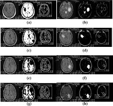 What does afdl stand for? Using The Afdl Method To Classify Eight Mri Samples Into Astrocytoma Download Scientific Diagram