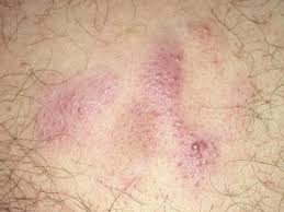 Image result for Lymphoma