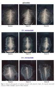 15 Minoxidil Before And After Minoxidil Skin Care Hair Care Sensitive Scalp