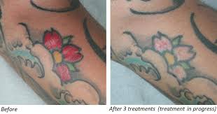 Please include in your email the city / town where you will preform laser tattoo removal treatments and we will respond during business hours. Tattoo Removal Before After Visual Results Dekalaser