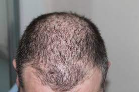 The most common forms of temporary hair loss occur: Why Does Transplanted Hair Fall Out Ilajak Medical