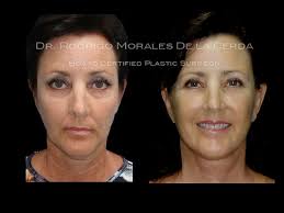 Rejuvenecimiento facial