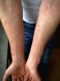 Image result for allergy rash on the legs