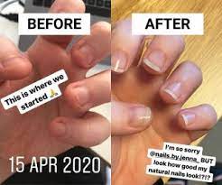 Take progression to document not only the recovery, but also your success. How To Stop Nail Biting After 20 Years This Is How I Finally Broke My Biting Habit