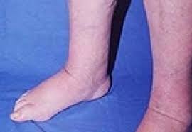 Manifestarile (simptomele) picioarelor umflate si gleznelor umflate depind pentru situatia in care umflarea picioarelor este dureroasa, medicul tau. De Ce Se Umfla Picioarele Cauze Posibile Cancer Glezne Umflate Si Rosii