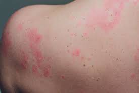 The rashes can take many forms — some appear as tiny red spots, while others appear as larger flat or raised lesions. These Skin Conditions Could Mean You Re Carrying The Coronavirus Huffpost Life