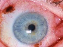 Image result for conjunctival melanoma