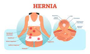 4 333 Hernia Stock Photos Pictures Royalty Free Images Istock
