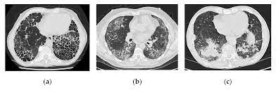 Jcm Free Full Text Interstitial Lung Disease In Rheumatoid Arthritis Remains A Challenge For Clinicians Html