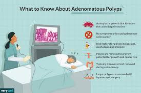 We find polyps in at least 25 percent of men and women over the age of 50 through colonoscopies. Adenomatous Polyp Symptoms Causes Diagnosis And Treatment