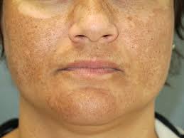 A visitor is also required to prove his financial ability to stay in malaysia and possess a confirmed return travel ticket or a travel ticket to a third country. Platelet Rich Plasma For Melasma Will It Fade Forever Global Stem Cells Group