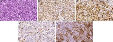 Blood, the journal of the american society of hematology. Morphologic Aspects Of Angioimmunoblastic T Cell Lymphoma A Download Scientific Diagram