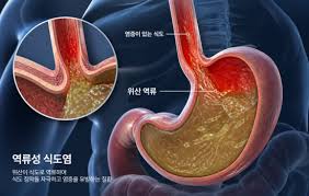 비수면 위내시경 후기 - 역류성 식도염 마이너 갤러리