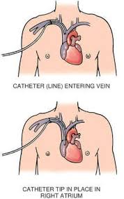 Catheter Catheter Oncology Nursing Critical Care Nursing