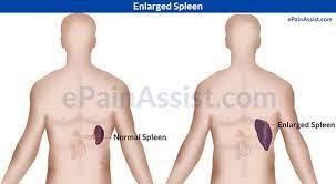 Enlarged Spleen|Etiology|Risk  Factors|Signs|Symptoms|Investigations|Treatment