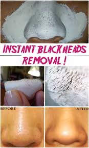 say goodbye blackheads in 15 minutes