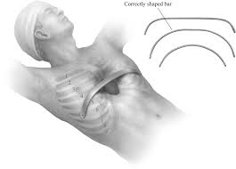 Image result for Pectus Excavatum