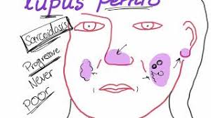 You may have recurrences seasonally for years. Lupus Pernio With A Mnemonic Youtube