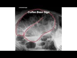 Image result for Sigmoid Volvulus