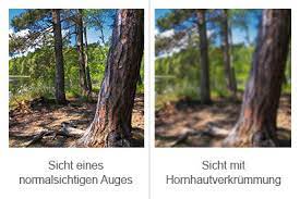 Hornhautverkummung Astigmatismus