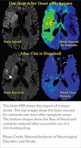 We did not find results for: Vascular Dementia Symptoms Treatments Alz Org