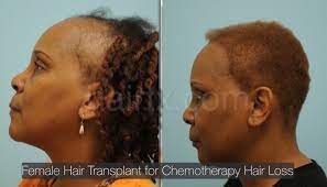 Hair transplant practices have a very low patient volume, as we only perform one procedure per day and only dr. Ethnic Hair Restoration Dallas Ethnic Hair Surgery Plano Tx