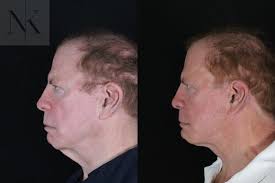 Chin Implant Before and After Photo Gallery